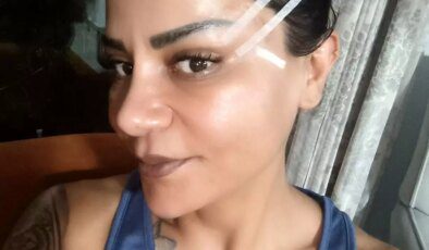 Antalya’da Estetik Operasyon Mağduriyeti: 220 Bin TL’lik Sürecin Ardından Davalık Oldu